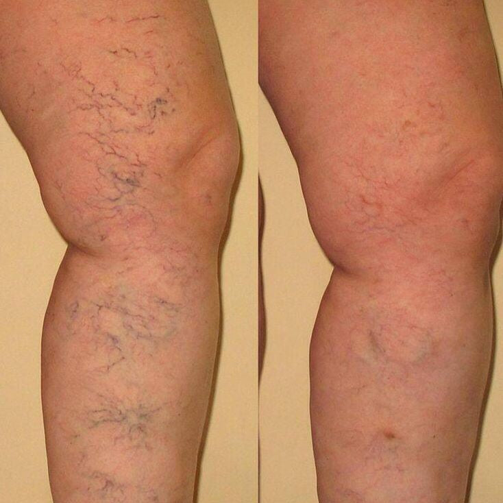 RelaxStep®: Reduce la hinchazón y el dolor por varices sin agujas
