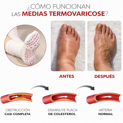 RelaxStep®: Reduce la hinchazón y el dolor por varices sin agujas